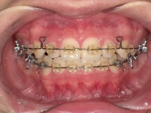 wire orthodontics