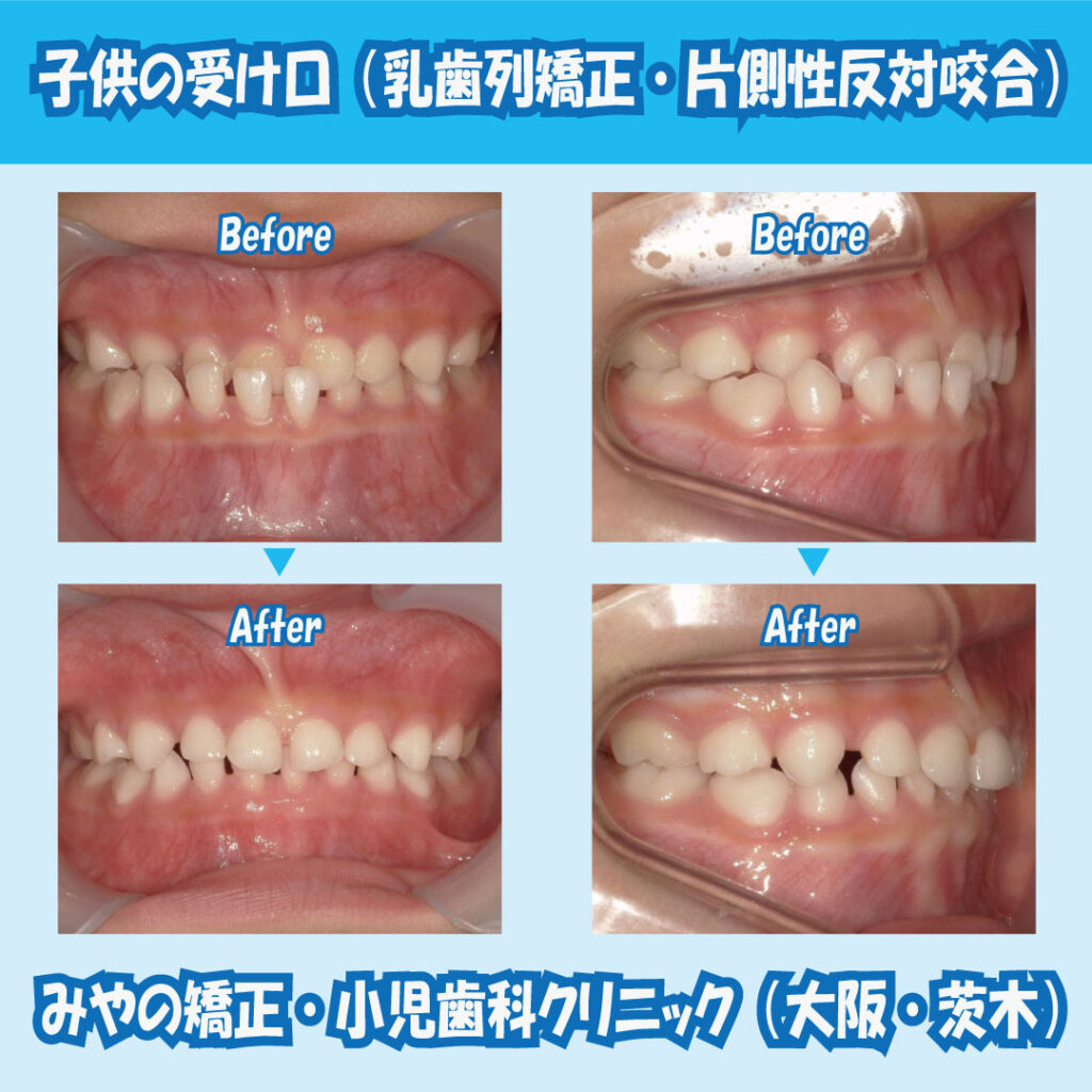 大注目】 マウスピース 反対咬合 Mサイズ