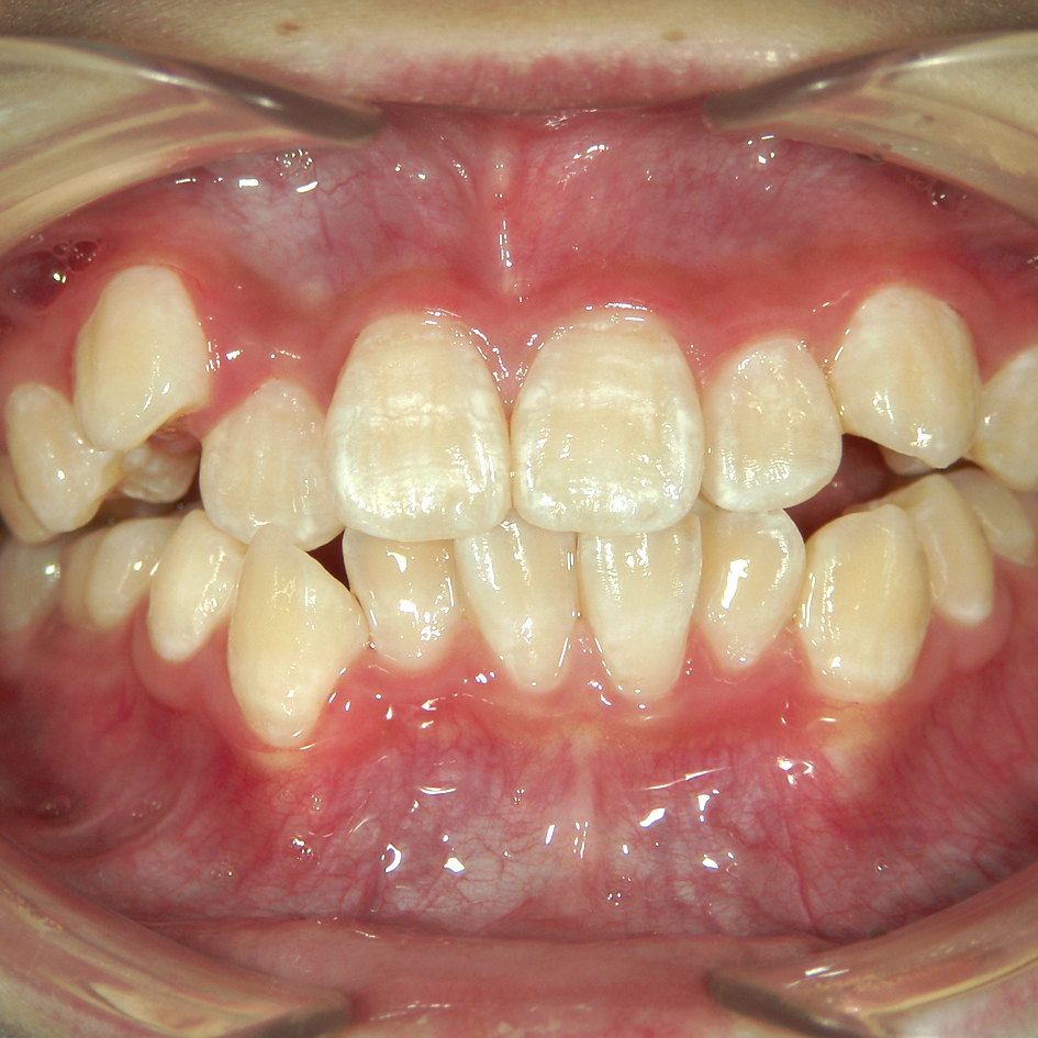 子供の歯列の問題①上顎犬歯の埋伏・異所萌出