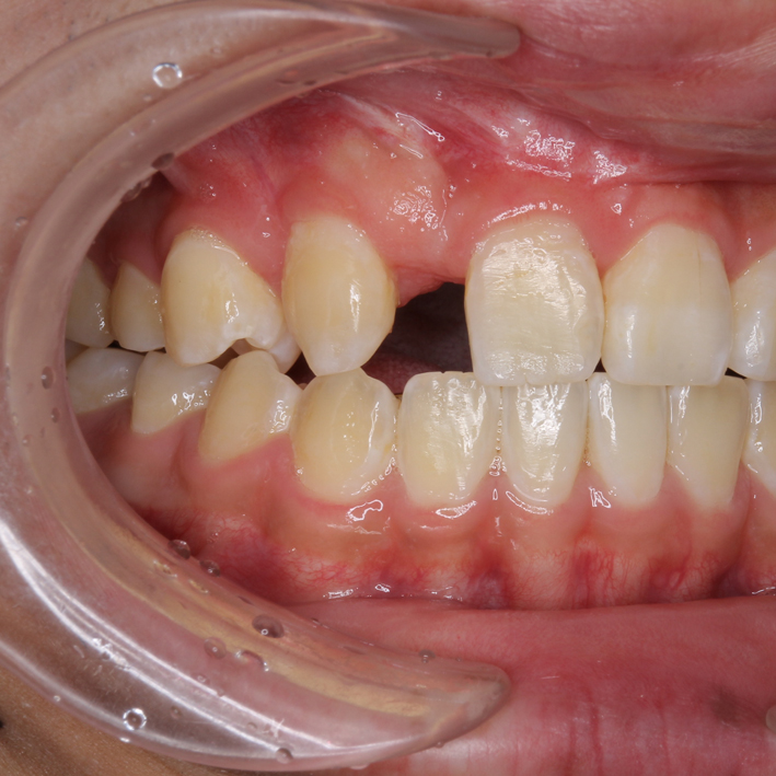 子供の歯列の問題②永久歯の先天性欠如