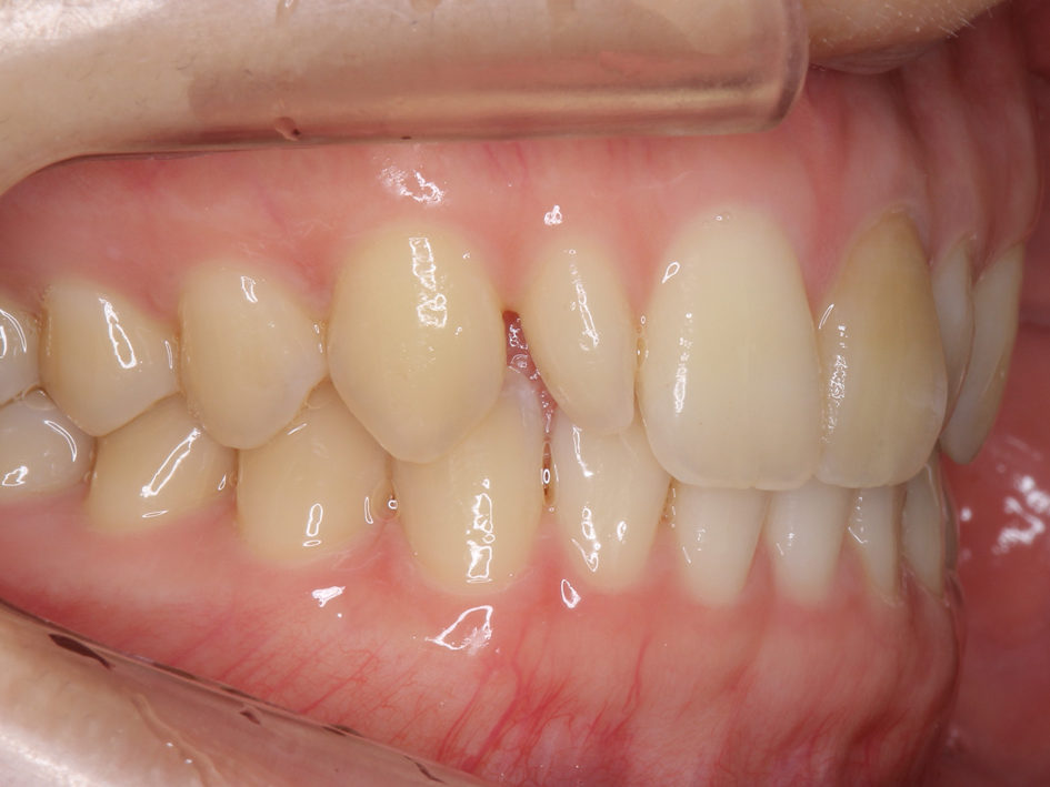 子供の歯列の問題④歯の形態異常