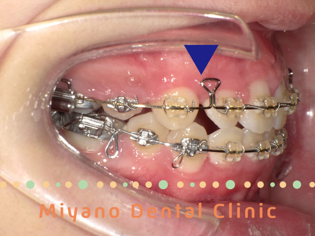 子供の歯列の問題⑤矮小歯がある場合の矯正治療