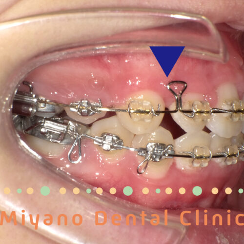 子供の歯列の問題⑤矮小歯がある場合の矯正治療