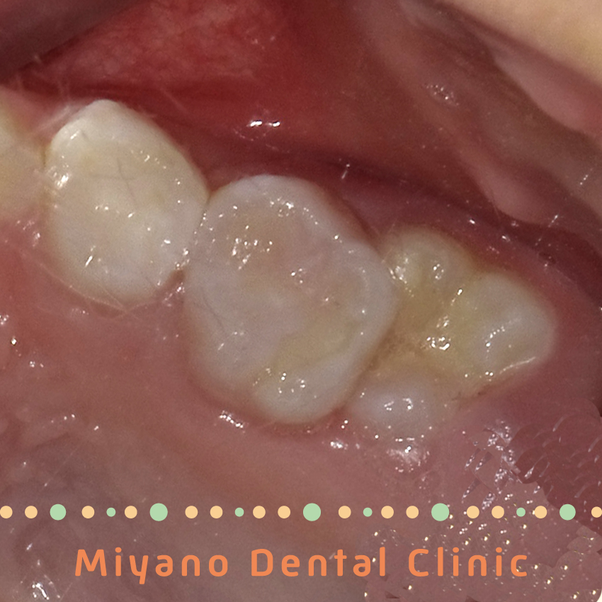 子供の歯並びの問題⑥上顎第一大臼歯(6歳臼歯)の異所萌出