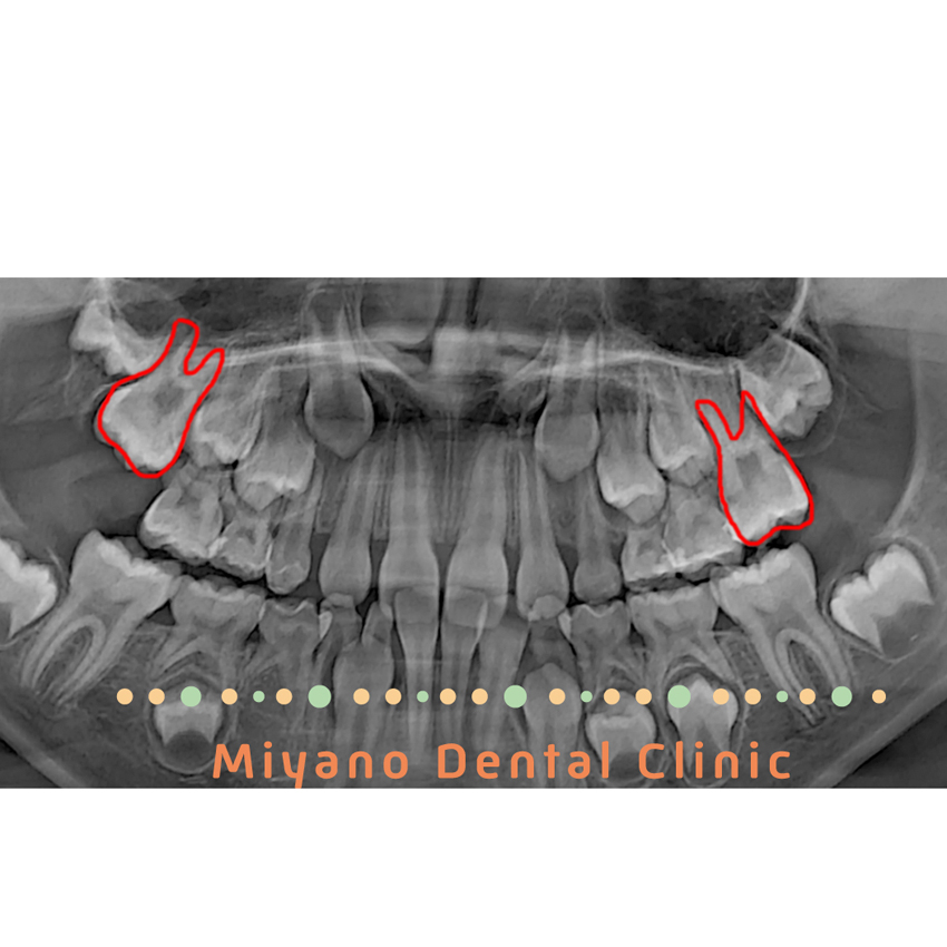 子供の歯並びの問題⑦第一大臼歯(6歳臼歯)の埋伏