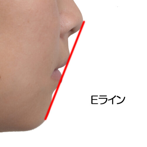 矯正治療とEライン