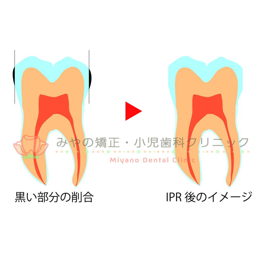 インビザラインとIPR（歯の削合）