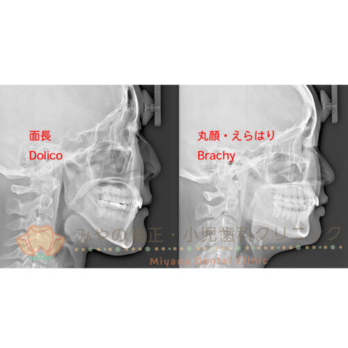 面長・丸顔・えらはり顔と矯正治療