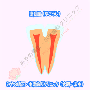 癒合歯と矯正治療