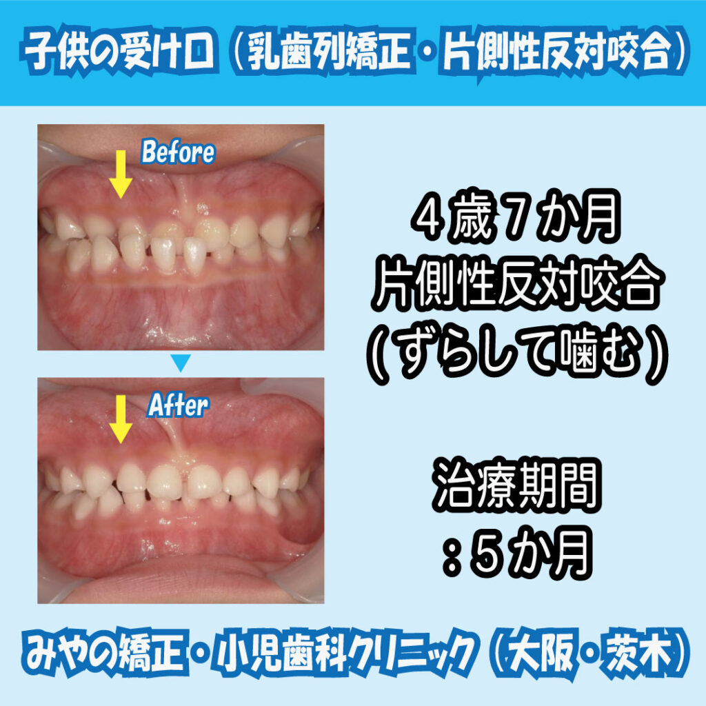 未就学児の受け口の矯正治療について