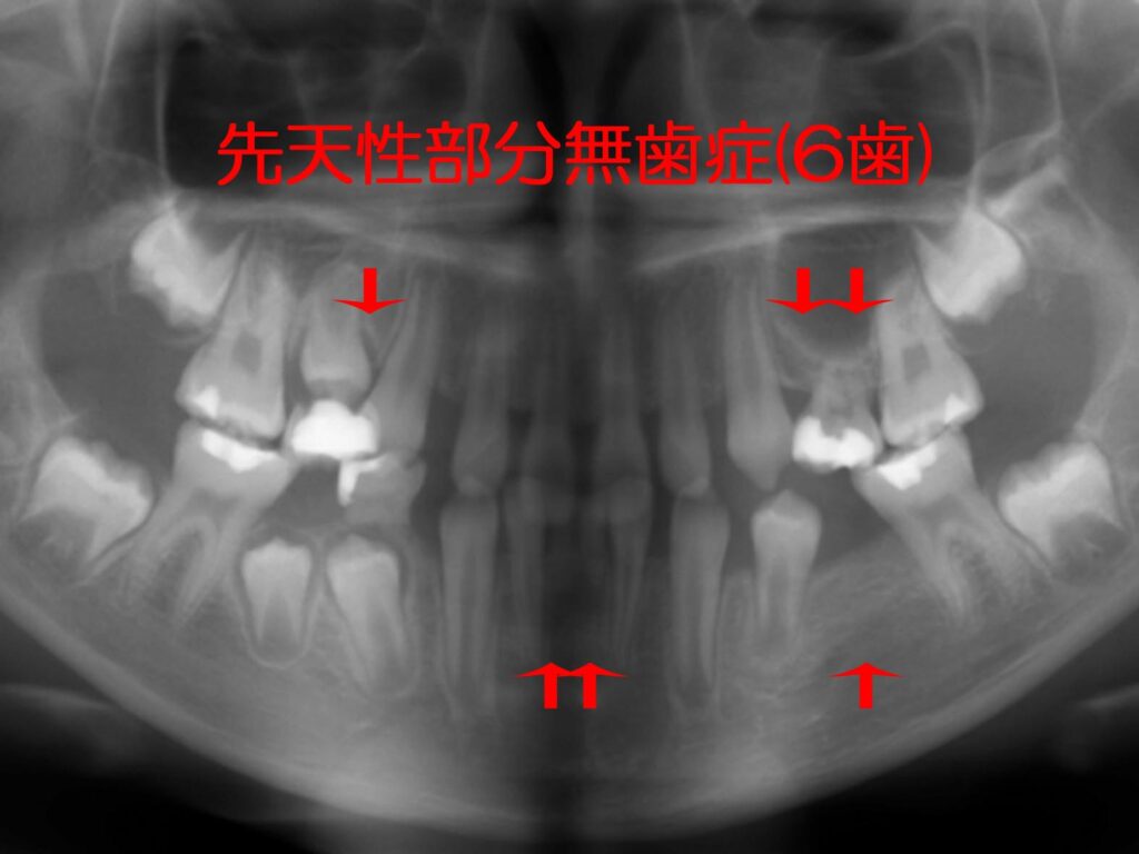 多数歯先欠・６歯以上の先天性部分無歯症の矯正治療