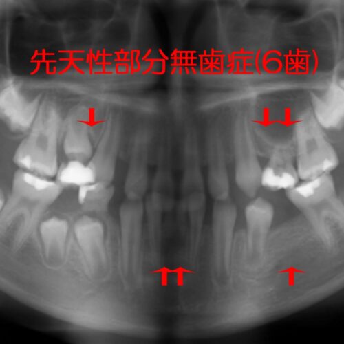 多数歯先欠・６歯以上の先天性部分無歯症の矯正治療