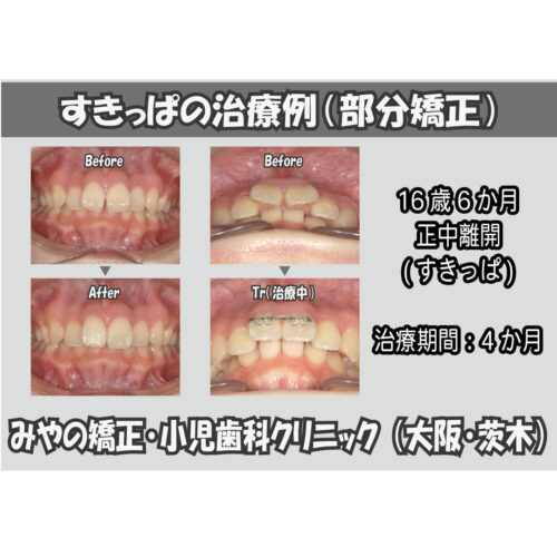 すきっぱの部分矯正と全体矯正