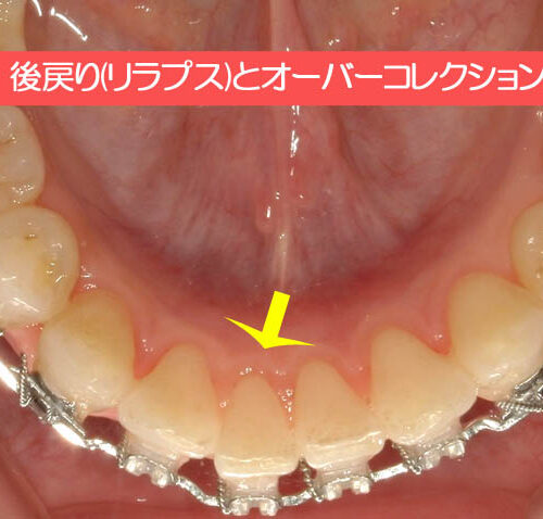 後戻り(リラプス)とオーバーコレクション