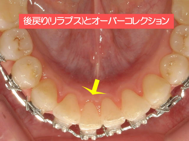 後戻り(リラプス)とオーバーコレクション