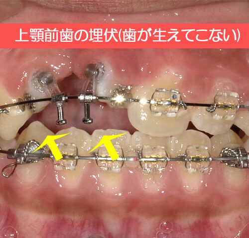 上顎前歯の埋伏(前歯が生えてこない)