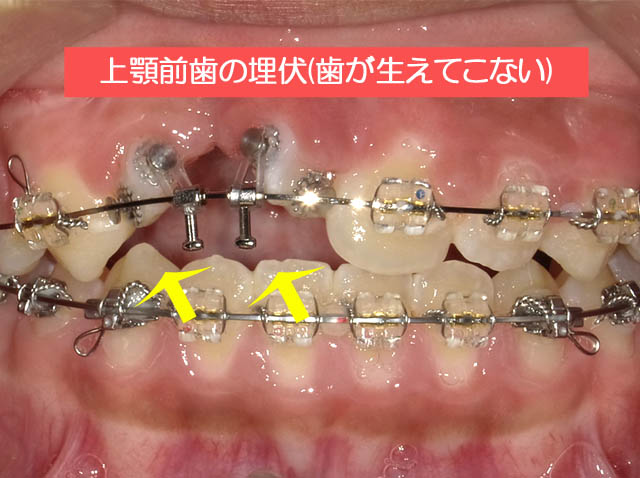 上顎前歯の埋伏(前歯が生えてこない)