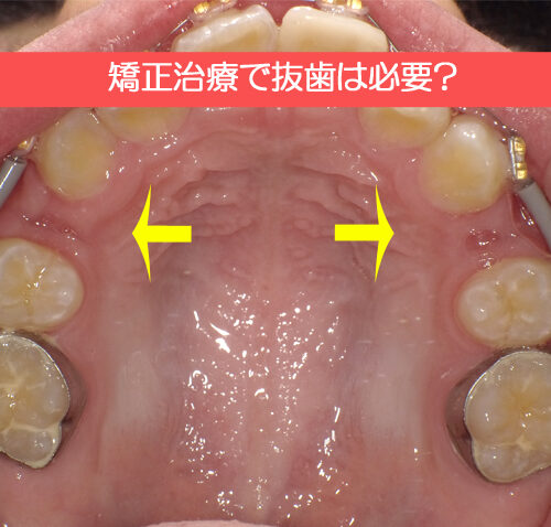 矯正治療で歯を抜かないといけない？