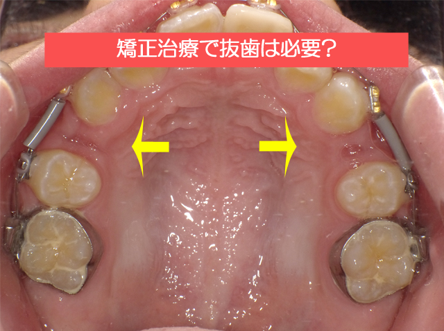 矯正治療で歯を抜かないといけない？