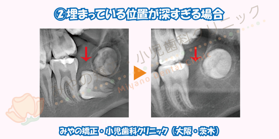 12歳臼歯埋伏の治療例