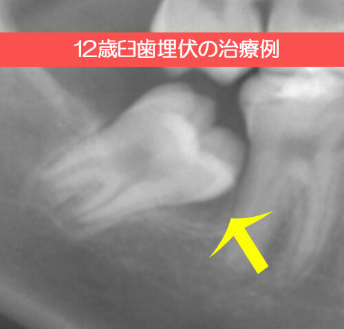 12歳臼歯埋伏の治療例