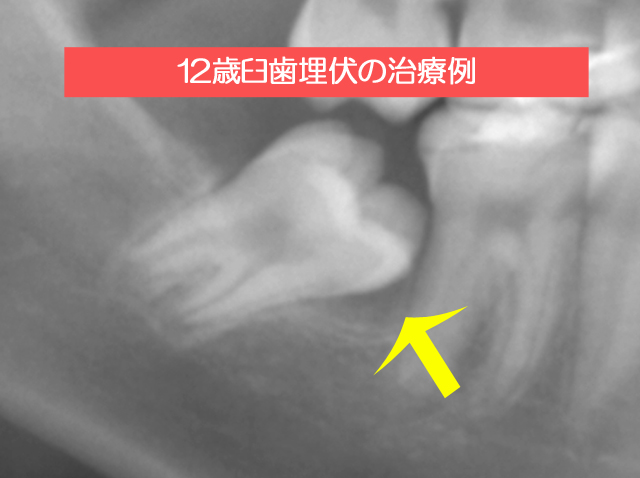 12歳臼歯埋伏の治療例