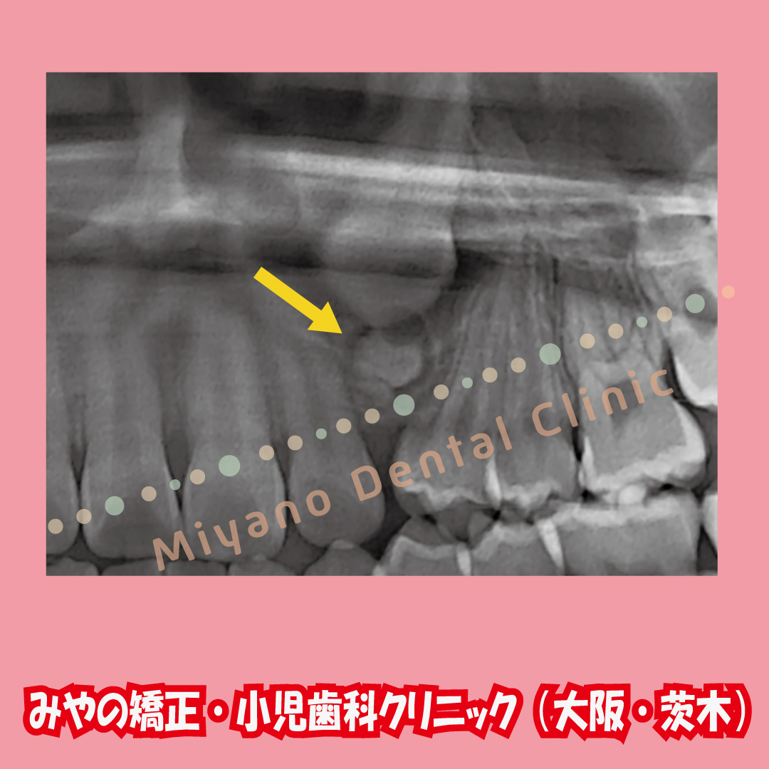 過剰歯の歯並びへの影響