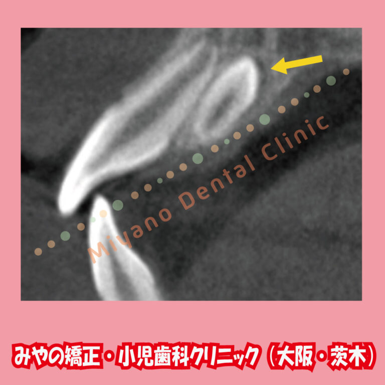 過剰歯の歯並びへの影響