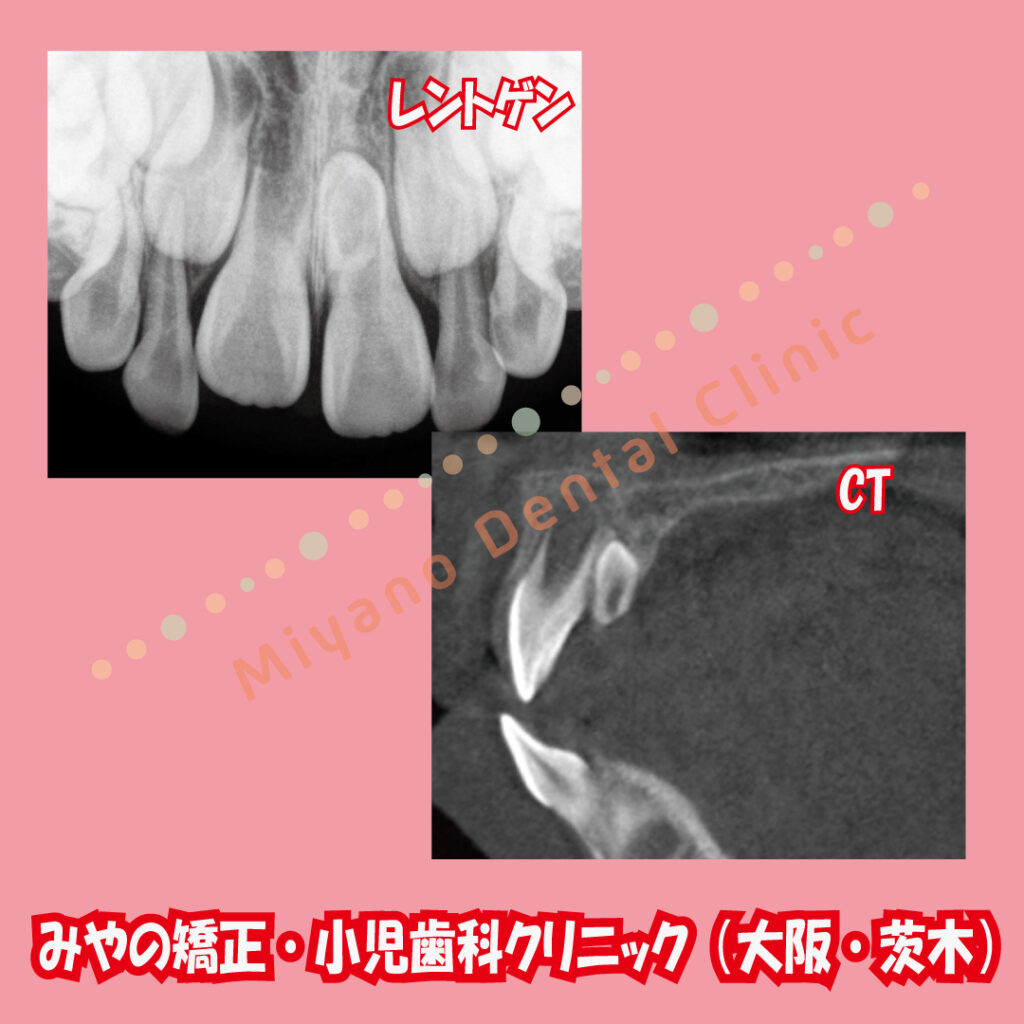 過剰歯の歯並びへの影響