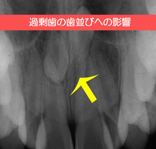 過剰歯の歯並びへの影響