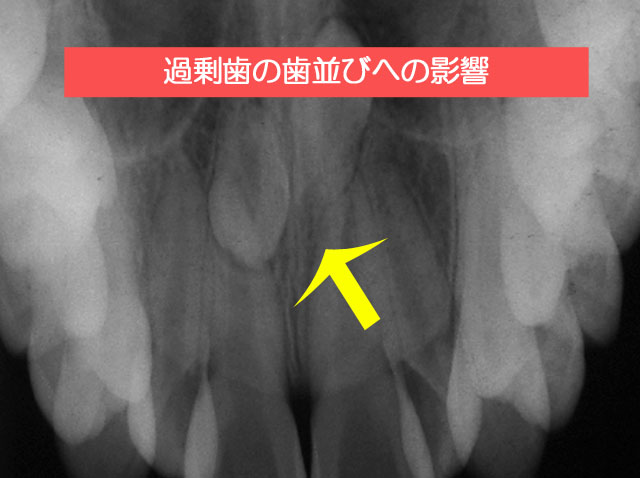 過剰歯の歯並びへの影響