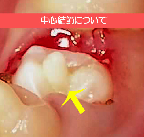中心結節について
