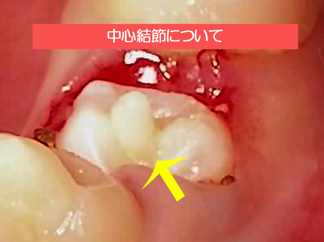 中心結節について