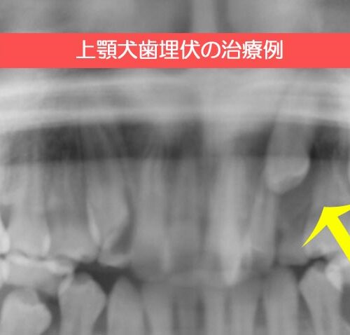 上顎犬歯埋伏に対する矯正治療例