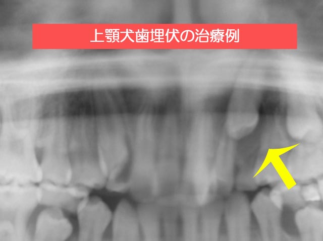 上顎犬歯埋伏に対する矯正治療例