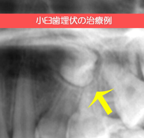 小臼歯埋伏に対する矯正治療例