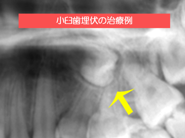 小臼歯埋伏に対する矯正治療例