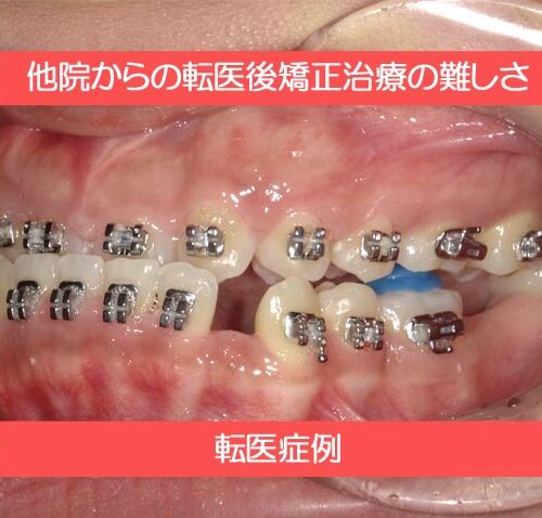 他院からの転医後矯正治療の難しさ