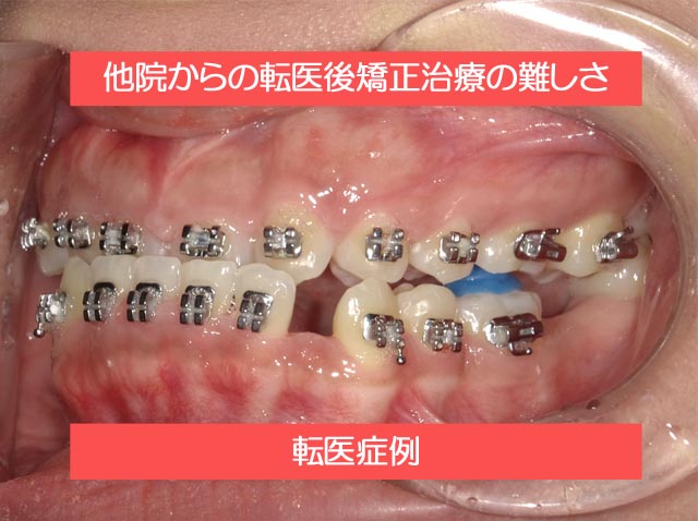 他院からの転医後の矯正治療の難しさ