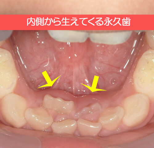 内側から生えてくる永久歯