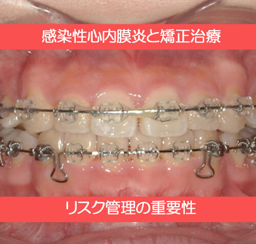 感染性心内膜炎と矯正治療について