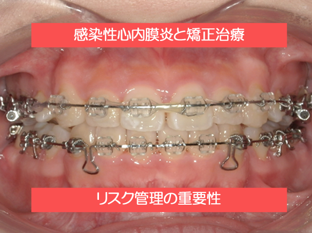 感染性心内膜炎と矯正治療について