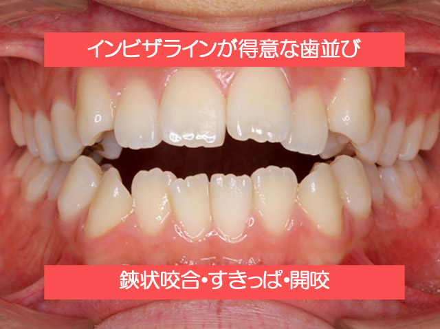 インビザラインが得意な歯並びについて