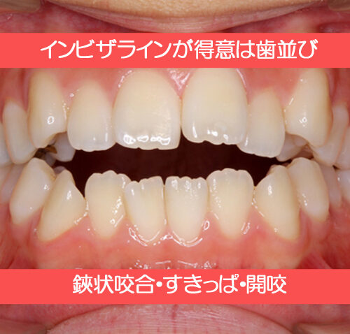 インビザラインが得意な歯並びについて