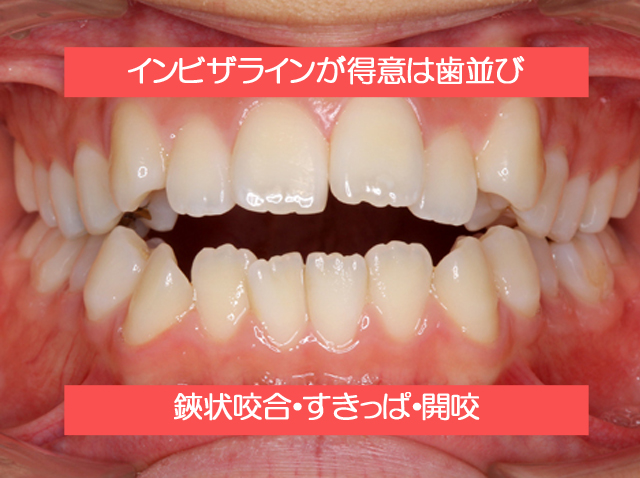 インビザラインが得意な歯並びについて