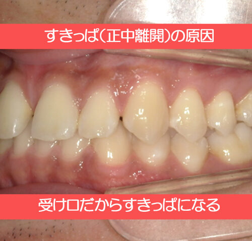 すきっぱの原因は受け口だから？