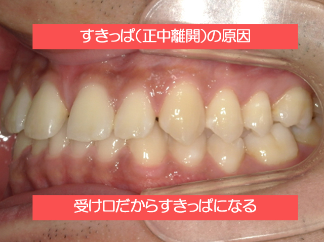 すきっぱの原因は受け口だから？