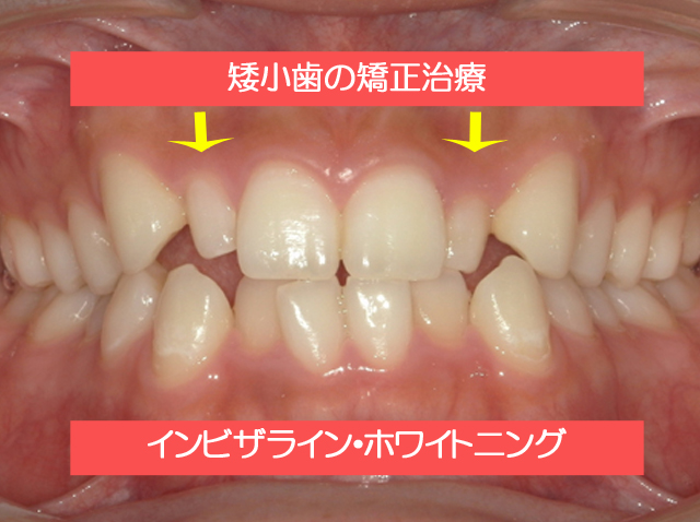 矮小歯の矯正治療（インビザライン）