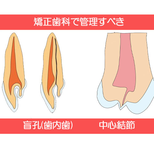 矯正歯科医院で管理すべき盲孔や中心結節