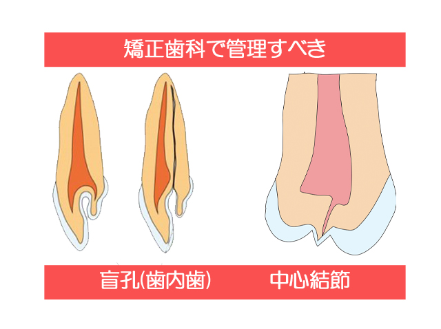 矯正歯科医院で管理すべき盲孔や中心結節